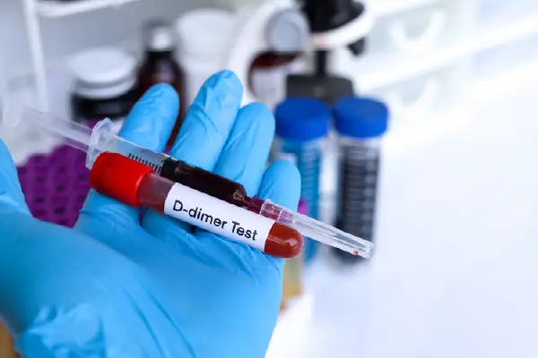 https://unitedveincenters.com/wp-content/uploads/2026/03/d_dimer_testAsset-1.webp