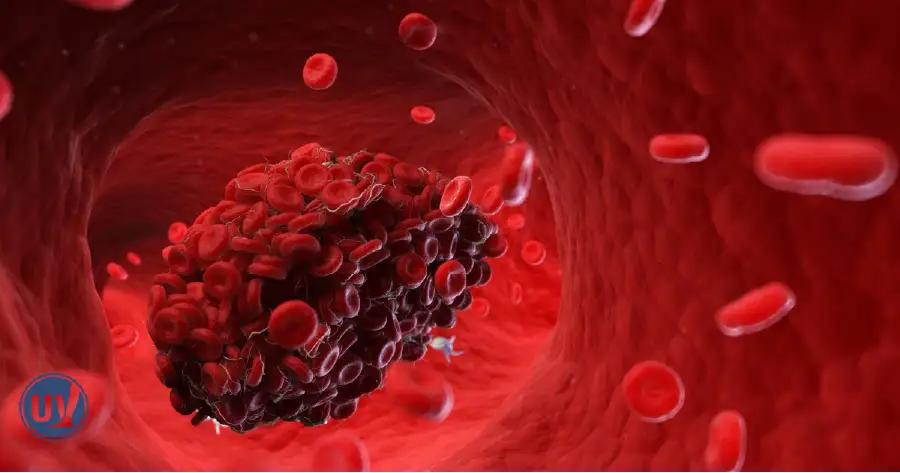 An illustration of a blood clot moving through a vein