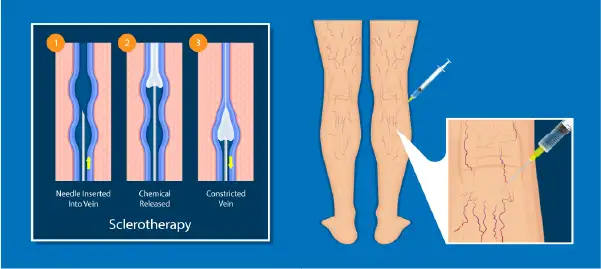 Illustration showing how sclerotherapy works to get rid of spider veins