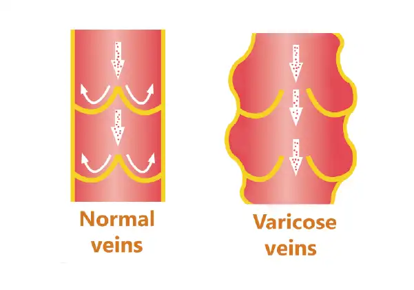 Illustration comparing normal and varicose veins