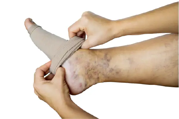 Putting compression socks on a foot with varicose veins