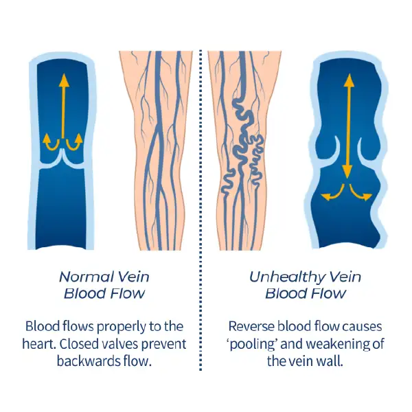 Causes of rope-like veins
