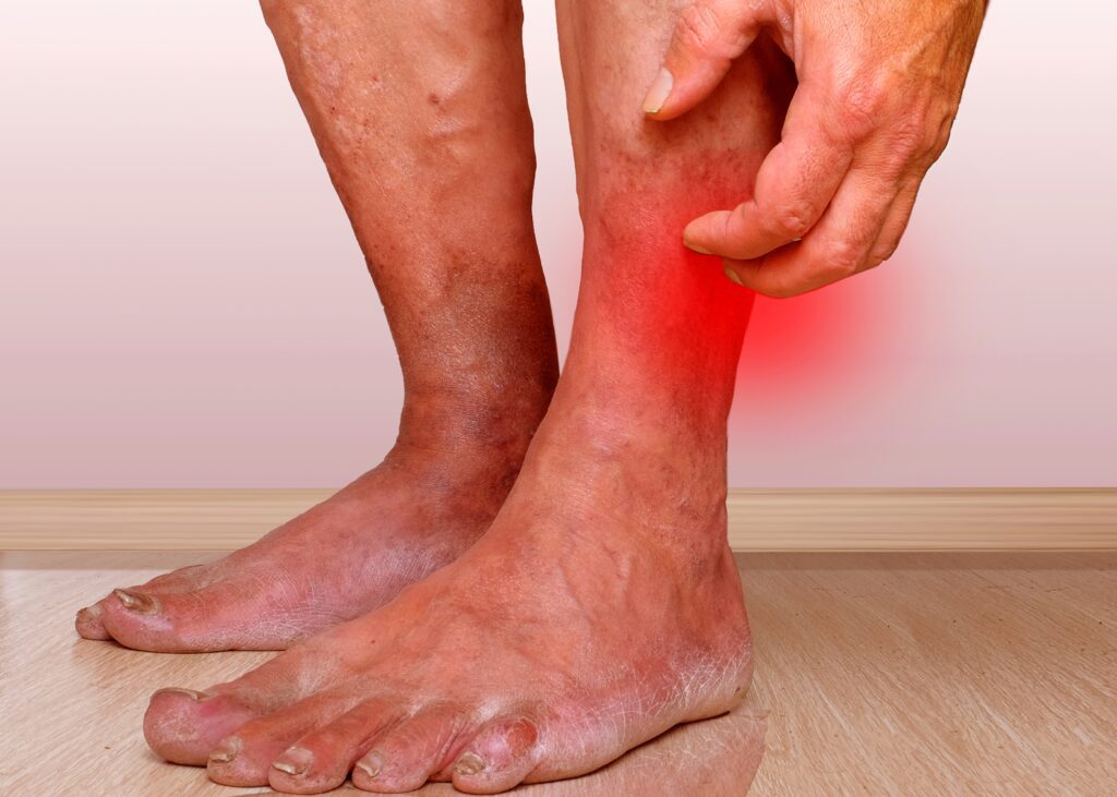 Legs itching and burning due to vein disease