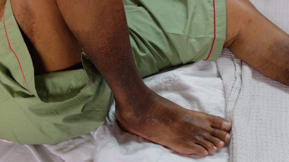 Skin discoloration on lower legs due to poor circulation