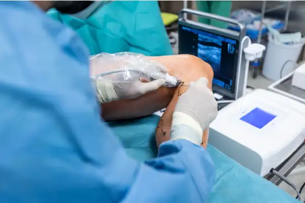 Targeted vein treatment procedure for varicose veins