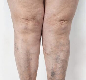 https://unitedveincenters.com/wp-content/uploads/2026/03/tvaricose_veins_2before.jpg