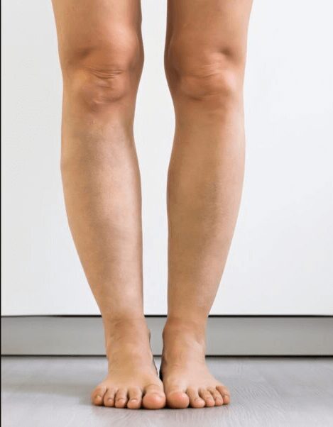 https://unitedveincenters.com/wp-content/uploads/2026/03/varicose_Veins_2-after.jpg