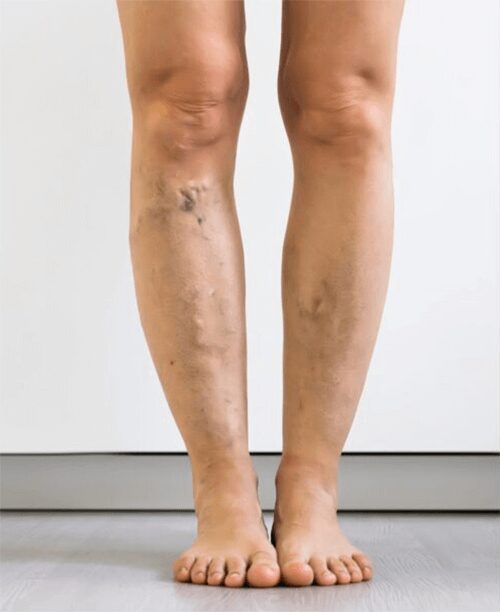 https://unitedveincenters.com/wp-content/uploads/2026/03/varicose_Veins_2-before.jpg