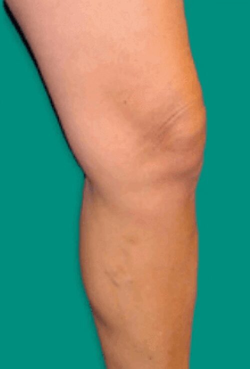 https://unitedveincenters.com/wp-content/uploads/2026/03/varicose_vein_1-after.jpg