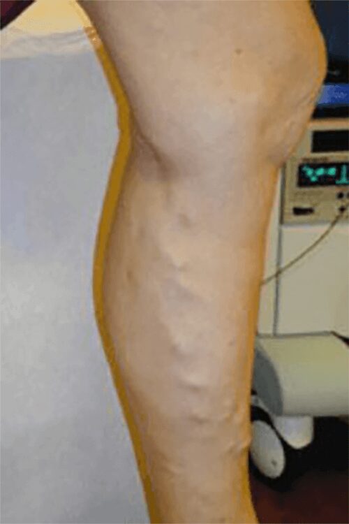 https://unitedveincenters.com/wp-content/uploads/2026/03/varicose_veins_3-before.jpg