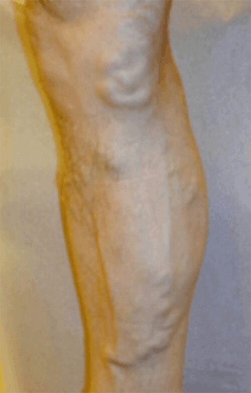 https://unitedveincenters.com/wp-content/uploads/2026/03/varicose_veins_4-before.jpg