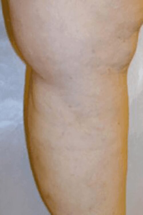 https://unitedveincenters.com/wp-content/uploads/2026/03/varicose_veins_5-after.jpg