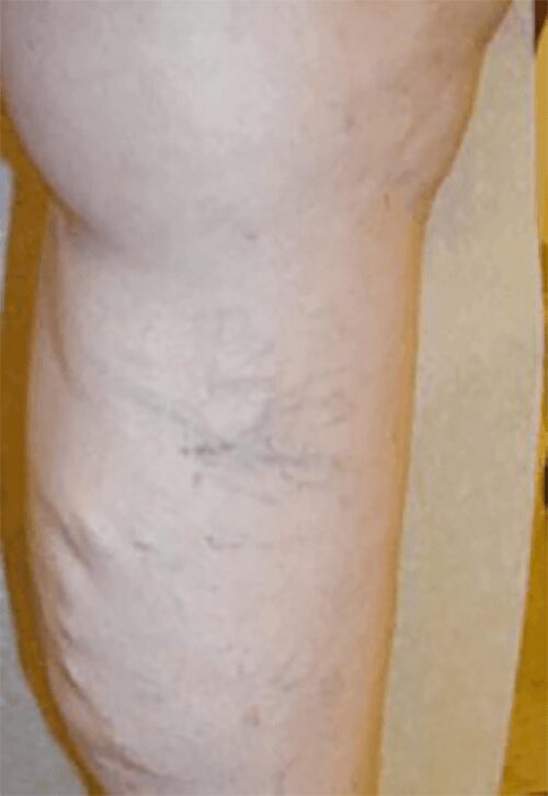 https://unitedveincenters.com/wp-content/uploads/2026/03/varicose_veins_5-before.jpg