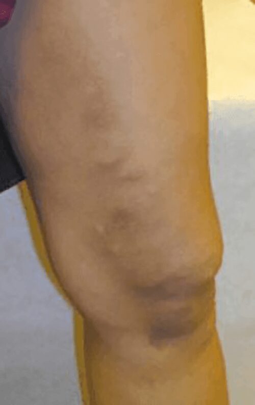 https://unitedveincenters.com/wp-content/uploads/2026/03/varicose_veins_6-after.jpg