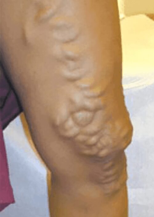 https://unitedveincenters.com/wp-content/uploads/2026/03/varicose_veins_6-before.jpg