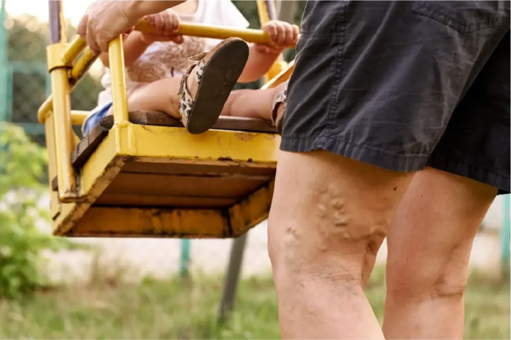 A person with varicose veins on their legs while pushing a small child on a swing