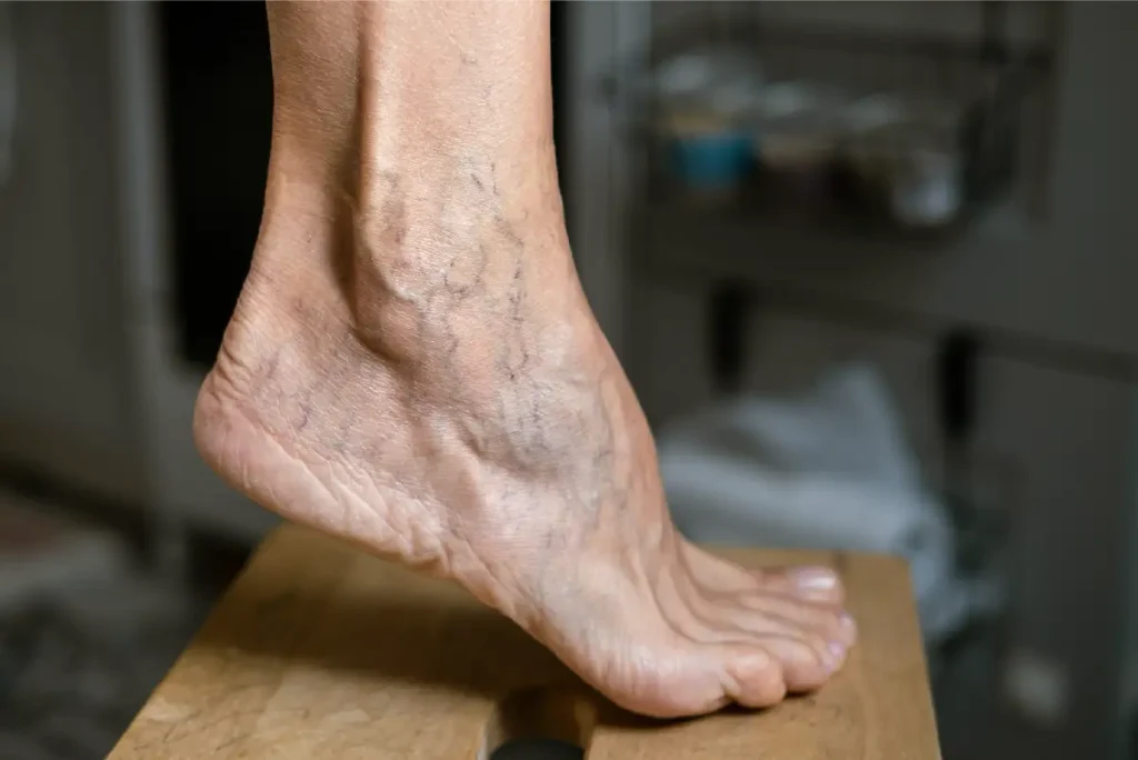 A foot with bulging varicose veins