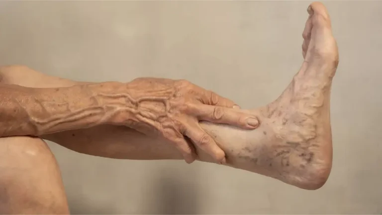 Senior citizen with bulging veins on hands and feet