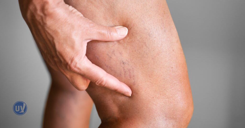 womans legs with visible veins