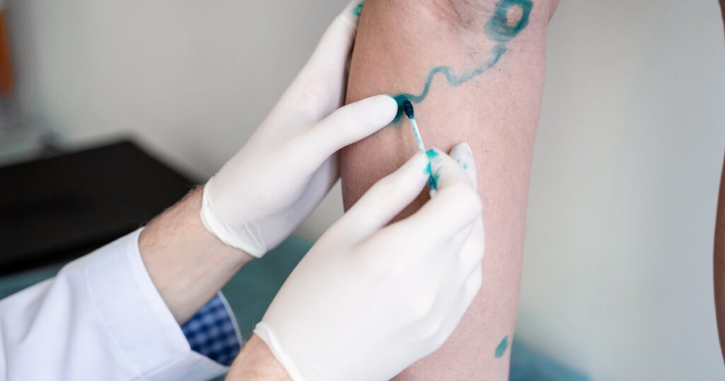 Varicose Vein mapping