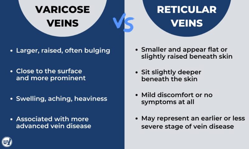Illustration describing the difference between varicose veins and reticular veins.