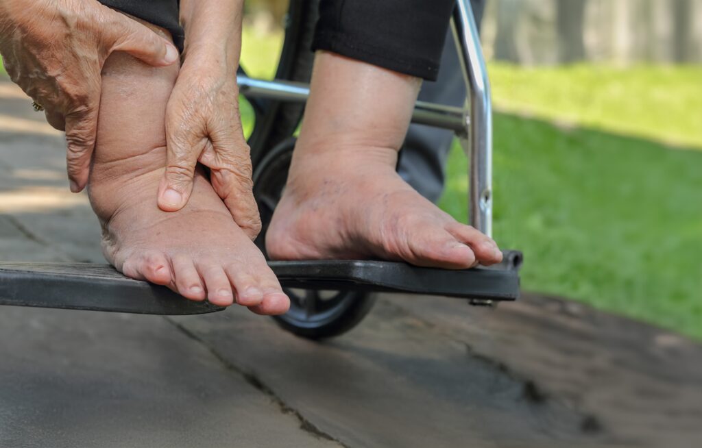 A person in a wheelchair holding their swollen feet while outside on a sunny day