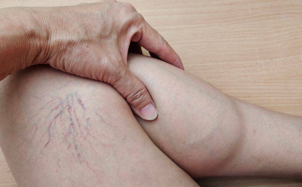 A person's thigh displaying several blue and purple squiggly veins