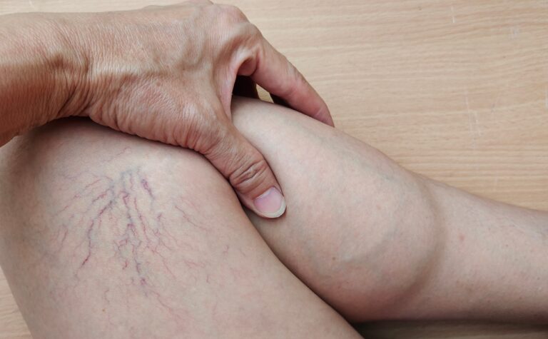 A person's thigh displaying several blue and purple squiggly veins