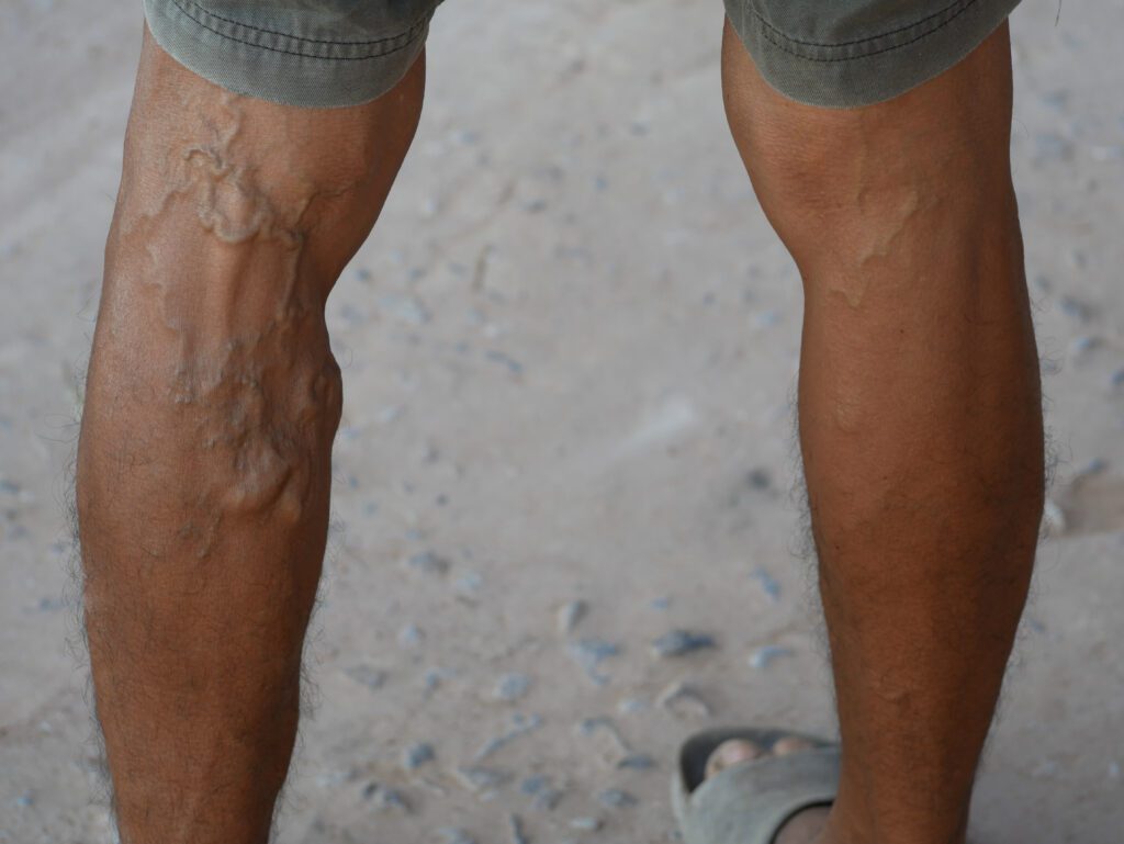 A man's legs with large, bulging varicose veins