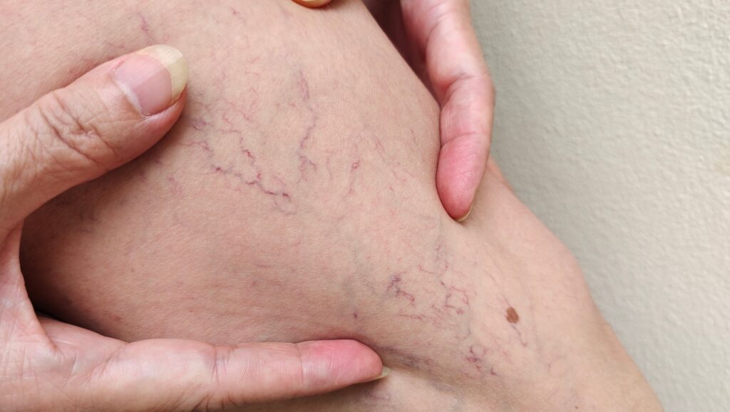 Close up photo of a leg with displaying several small blue and purple spider veins