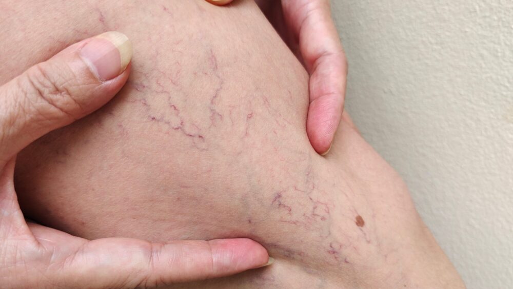 Small purple spider veins on a woman's lower leg