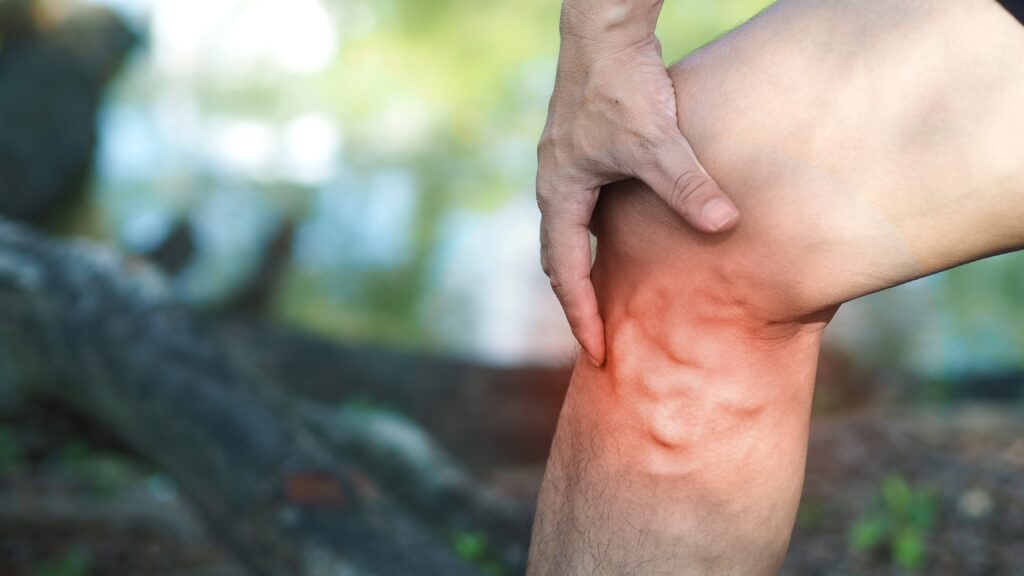 A person holding their knee showing several bulging veins extending to the calf