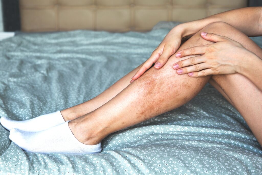 A person sitting on the bed with their legs displaying skin discoloration due to venous reflux