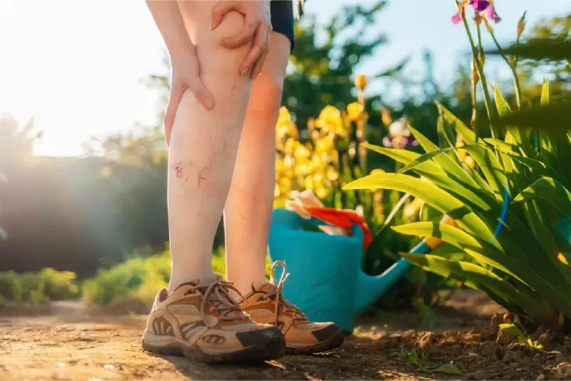 A woman grasping her calf with visible purple spider veins