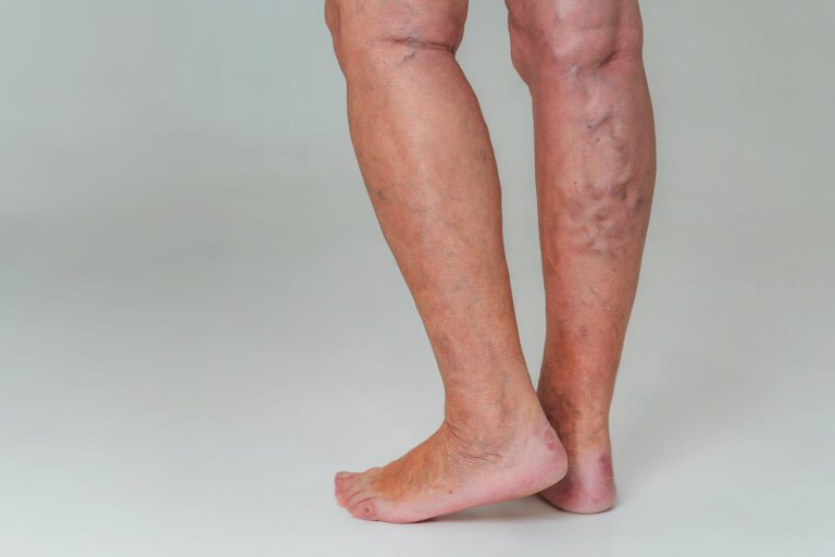 A person's legs are shown with a mix of reticular and varicose veins