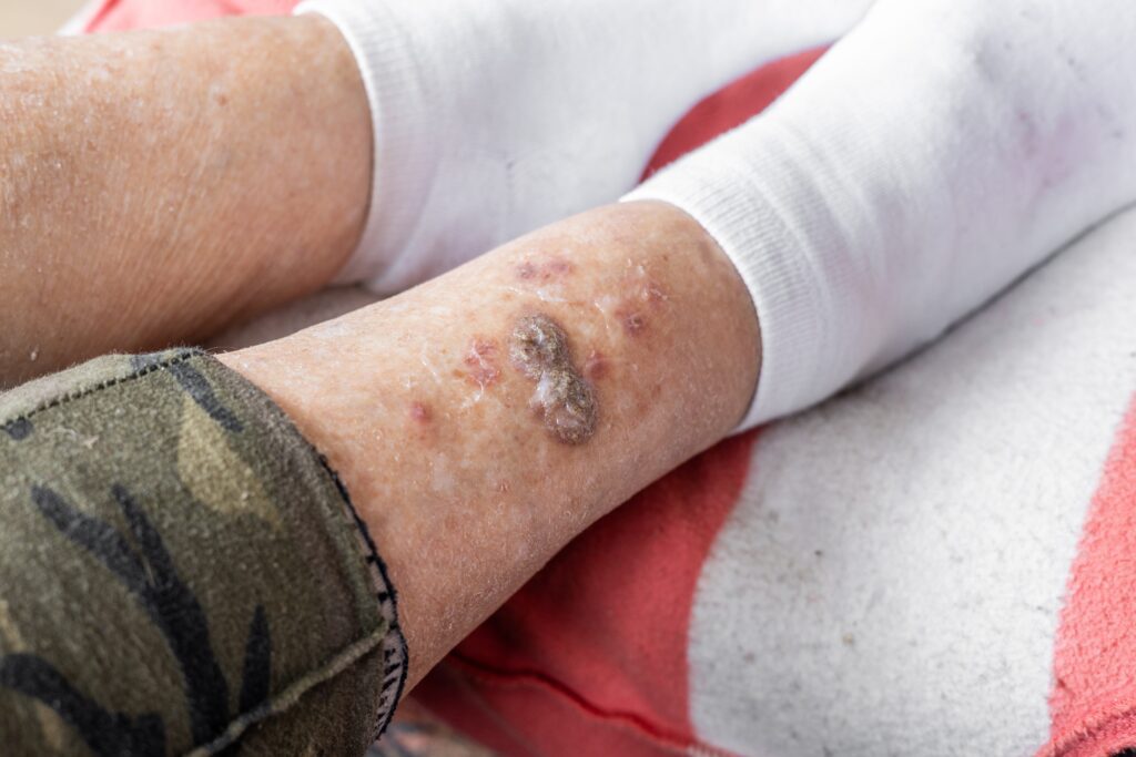 A person's lower leg displaying open sores that are due to vein disease