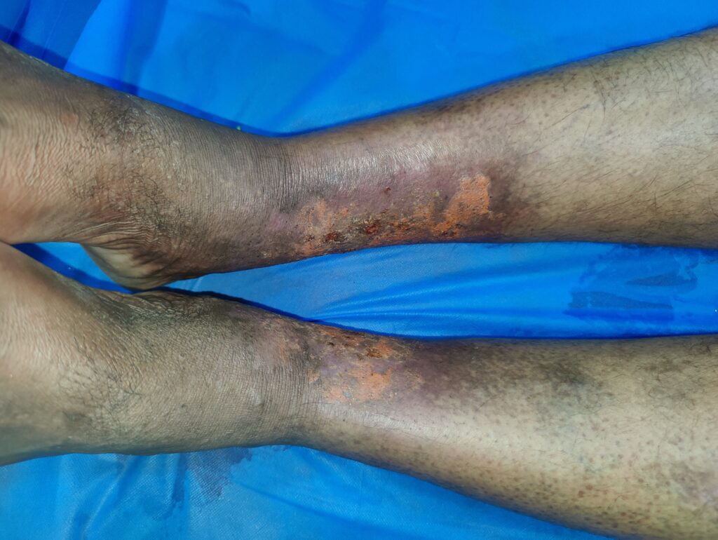 A man's ankles are shown with severe skin discoloration and venous ulcers