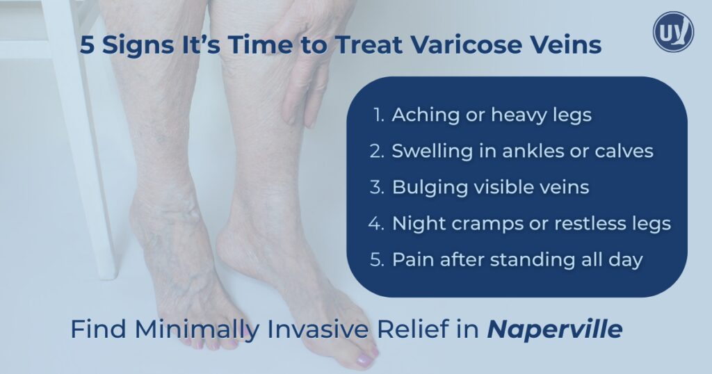 5 Signs Its Time to Treat Varicose Veins