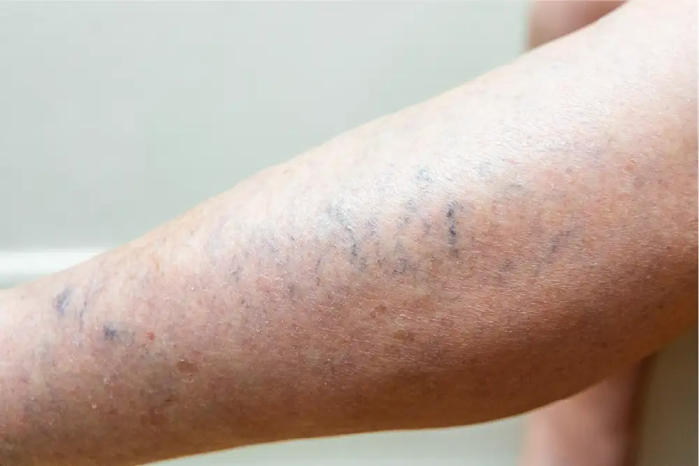 A lower leg is shown with several blue and purple visible veins and shiny, tight skin, indicating vein disease may be present