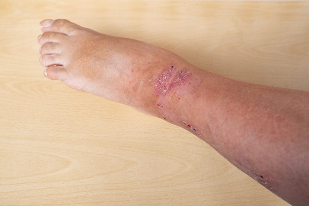 A lower leg shown with several slow-healing wounds due to vein disease