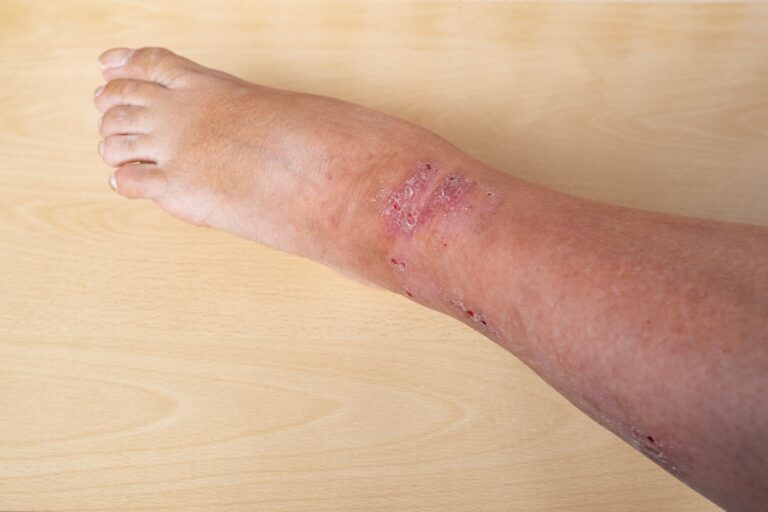 A lower leg shown with several slow-healing wounds due to vein disease