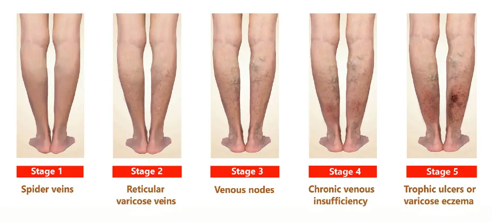 A chart showing and explaining the stages of varicose veins on lower legs