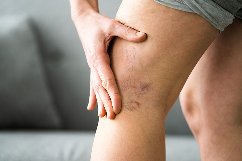 A person's legs shown with a large cluster of purple varicose veins, resembling a bruise