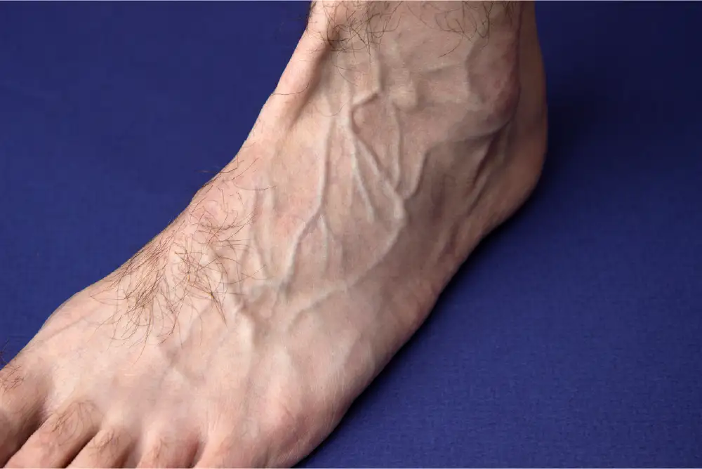 A close up of a man's foot showing bulging blue varicose veins