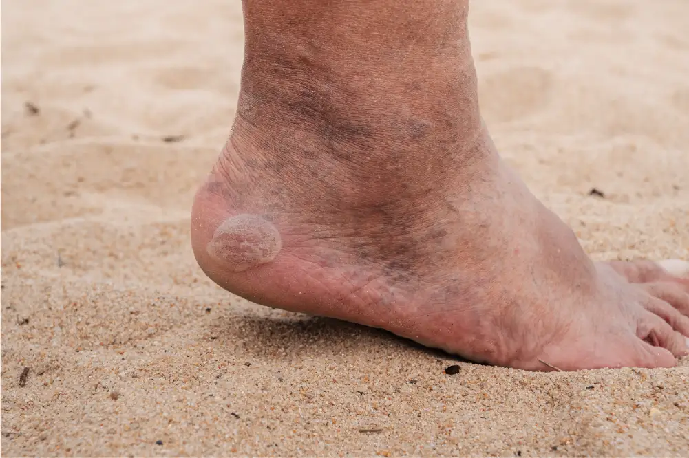 Signs and symptoms of venous stasis dermatitis