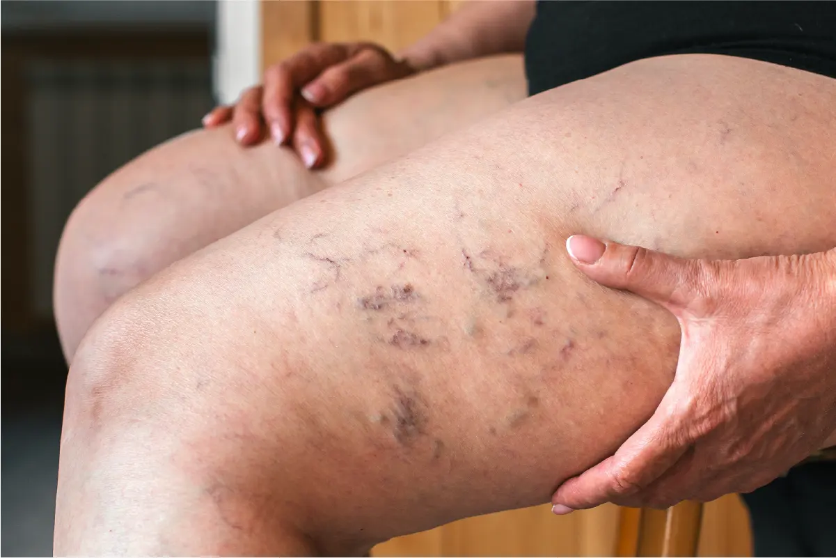 The side of a woman's thigh is shown with several purple and blue veins indicating the need for minimally invasive vein treatment