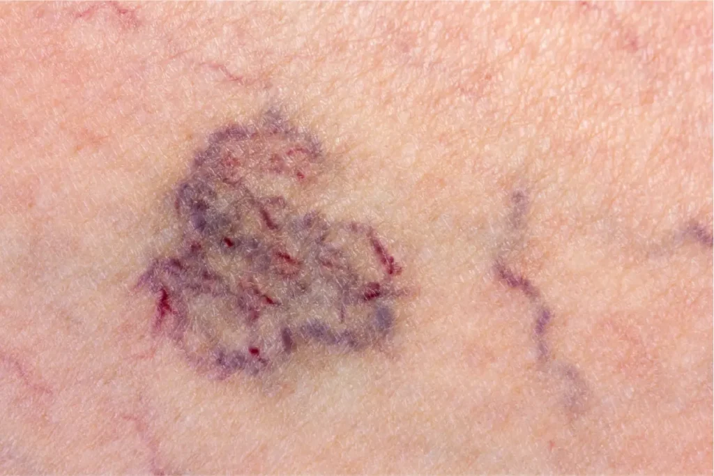 A close-up of several purple spider veins on a person's leg