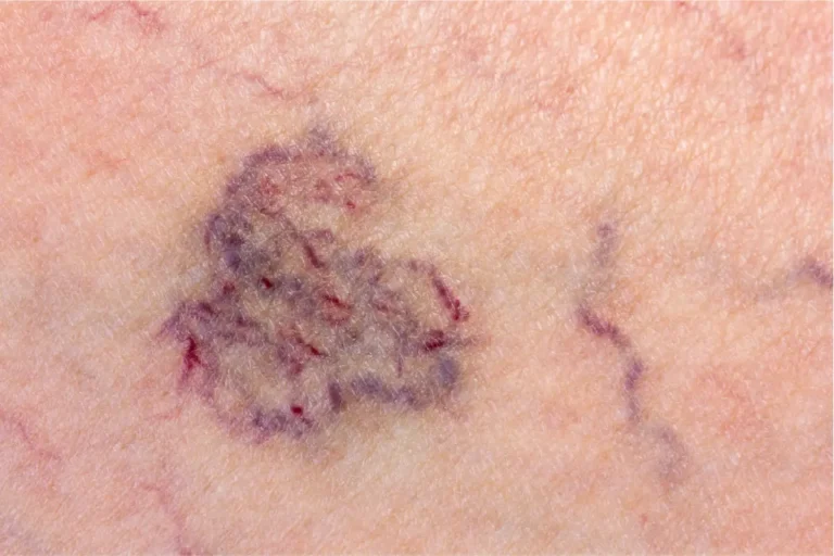 A close-up of several purple spider veins on a person's leg