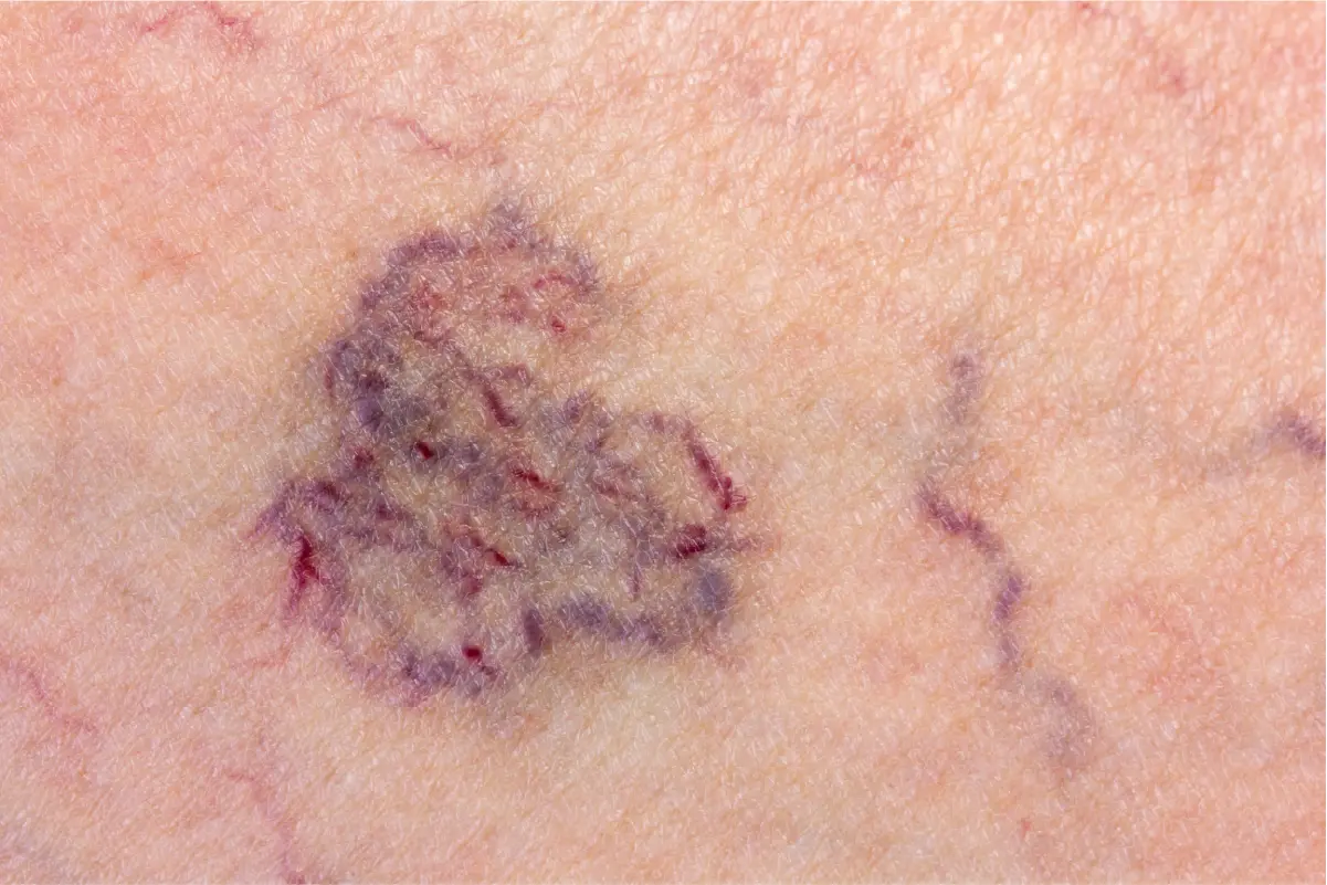 A close-up of several purple spider veins on a person's leg