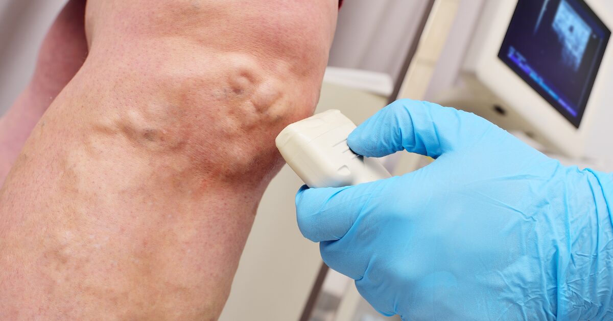 Vein doctor in Phoenix using ultrasound on patient vein